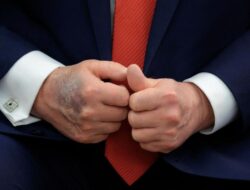 Misteri Memar di Tangan Donald Trump