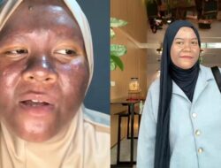 Awal Mula Kulit Wanita Ini Menggelap Gegara Krim Merkuri, Saat ini Bahkan Berangsur Pulih